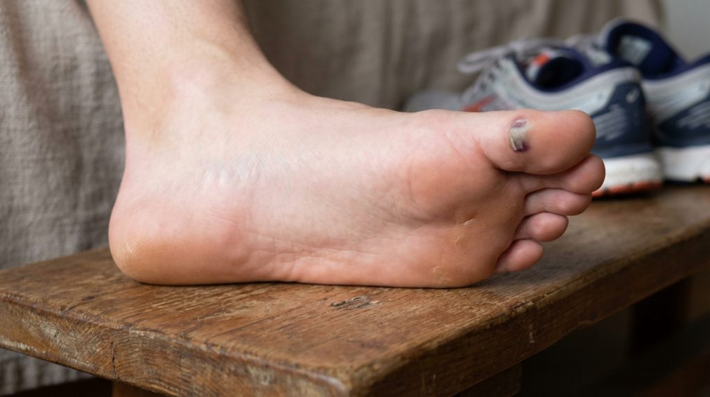 Gros plan sur un pied de coureur avec un ongle noir sur le gros orteil. Des chaussures de sport sont en arrière-plan flou.